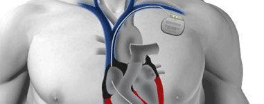 Crean un marcapasos biológico Crean un marcapasos biológico