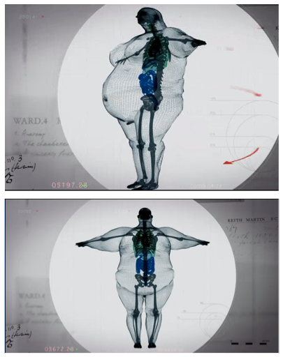 Efectos de la Obesidad en huesos y articulaciones