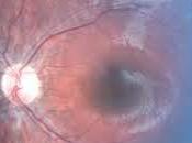 Tratamiento Prometedor Amaurosis Congenita