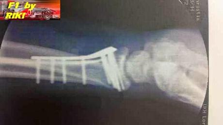 TOTO WOLFF SE FRACTURA CLAVICULOA, HOMBRO Y MUÑECA; AHORA PASA A LLAMARSE TOTONATOR