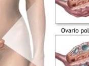 Consejos para Curar Quistes Ováricos
