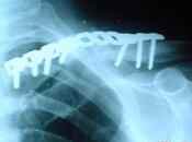 Mexicanas avanzan biomateriales