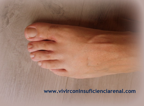 Protege tus pies de los hongos