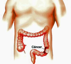 Evitar el Cáncer de Colon y Colonoscopias