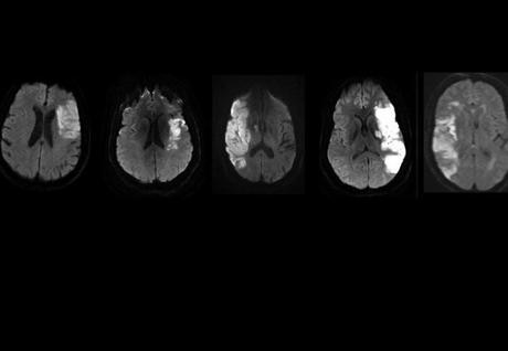 celulas madre accidentes cerebrovasculares