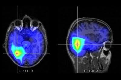 Los Accidentes Cerebrovasculares: Ictus y Derrame Cerebral (y II)