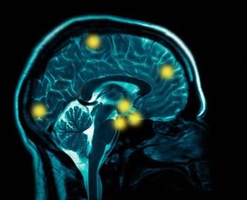 Los Accidentes Cerebrovasculares: Ictus y Derrame Cerebral (I)
