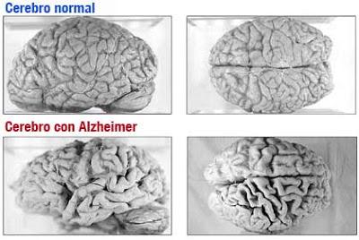 El Alzheimer: La Demencia más frecuente en el Envejecimiento (y III)