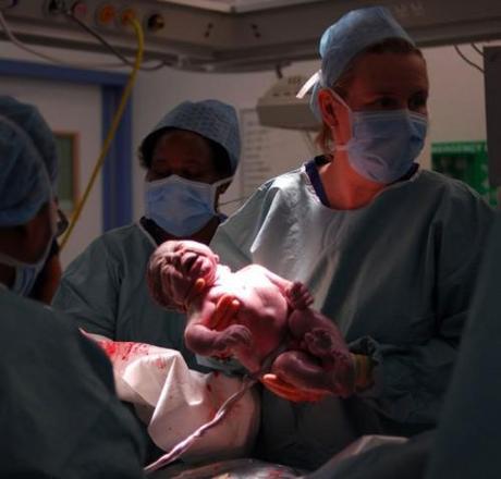 En ocasiones la cesárea es la mejor solución para los bebés que nacen en posición de nalgas Parto de nalgas