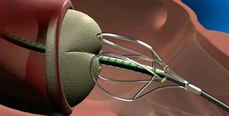 Tecnologia transcateter va dejando atras la cirugia a corazon abierto.