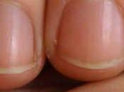 Síntomas uñas debes ignorar