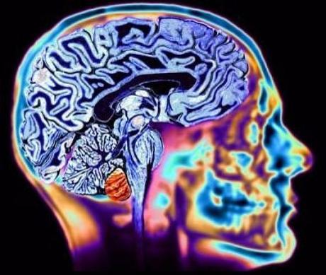 Avances moleculares en Huntington Avances moleculares en Huntington