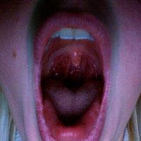 levantar el velo del paladar