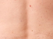 cosas debes saber sobre artritis psoriásica