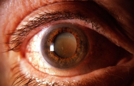 ¿Cómo afecta la Artritis Reumatoide a los ojos?