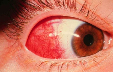 ¿Cómo afecta la Artritis Reumatoide a los ojos?