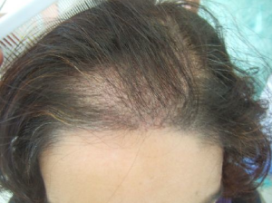 ¿La fibromialgia causa la pérdida de cabello? artricenter