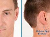 Bichectomia, solución para afinar rostro