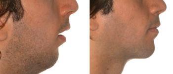 BICHECTOMIA, LA SOLUCIÓN PARA AFINAR TU ROSTRO ortodoncia17