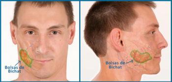 BICHECTOMIA, LA SOLUCIÓN PARA AFINAR TU ROSTRO page1_img4