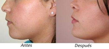 BICHECTOMIA, LA SOLUCIÓN PARA AFINAR TU ROSTRO bichectomia1