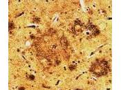 Alteraciones neuropsicológicas personas asintomáticas neuropatología enfermedad Alzheimer.