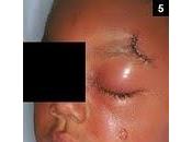 Celulitis ¡qué error, inmenso error!