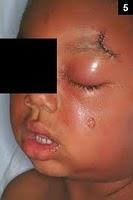 Celulitis , ¡qué error, qué inmenso error!