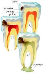 Importante Ariculo Acerca de las Caries Dentales!!!