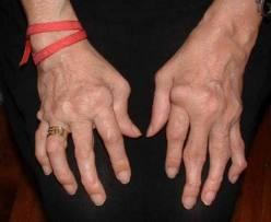 Población económicamente activa: la más afectada por enfermedades reumáticas