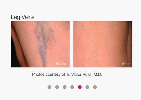 Resultados del Neodimio YAG