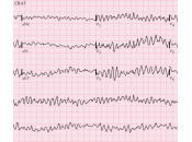 Preoperatorio