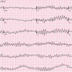 Electrocardiograma