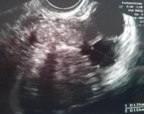 ecografía estimulación omifín