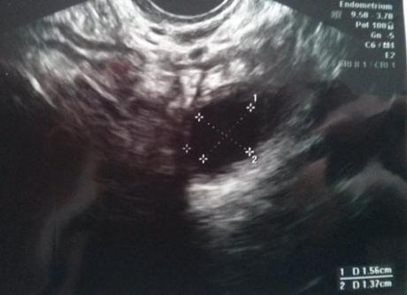 ecografía estimulación omifín