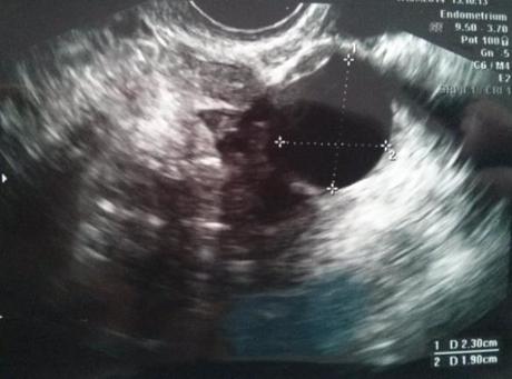 ecografía estimulación omifín