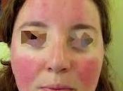 Cómo cuidar piel rosacea