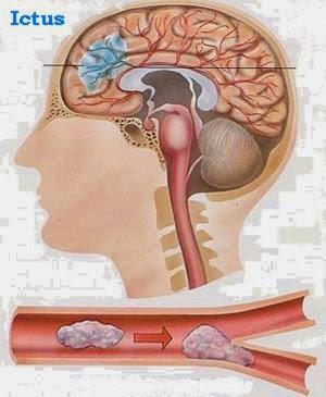 Exámenes de accidentes cerebrovasculares en abril