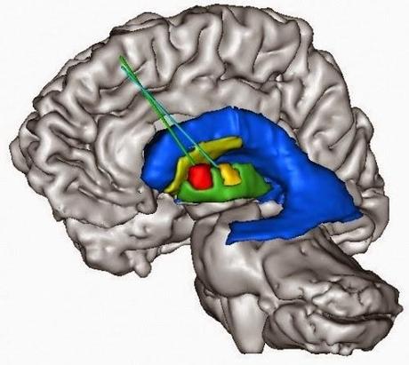 #35 Premio Relato Corto Sobre Enfermedades Raras: Corea de Huntington