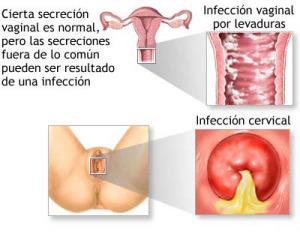 Curar Naturalmente Infección por Levaduras