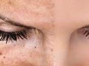 ¿por difícil tratar melasma?