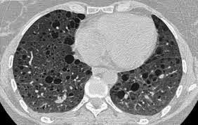 La Linfangioleiomiomatosis (LAM)