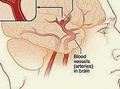 Noticias accidentes cerebrovasculares