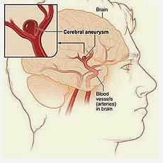 Noticias de accidentes cerebrovasculares