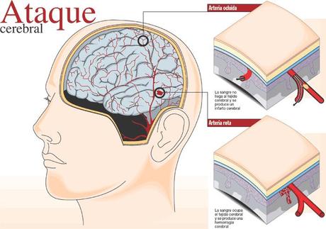 Noticias de accidentes cerebrovasculares