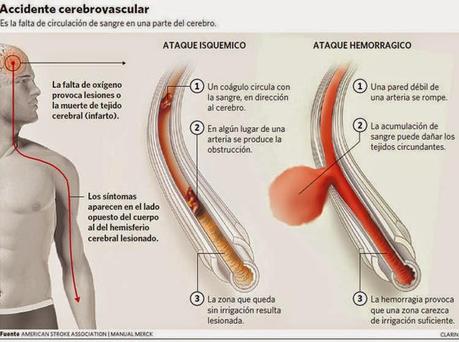 Noticias de accidentes cerebrovasculares