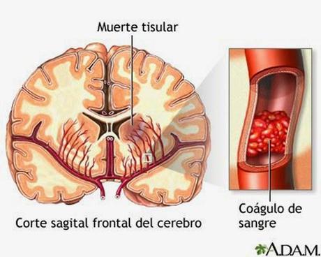 Noticias de accidentes cerebrovasculares