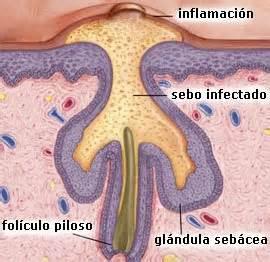 Esquema real de la infección. 