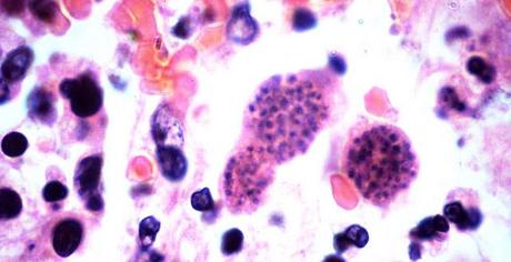 toxoplasmosis