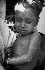 Janet Parker o cuando la viruela encontró el fallo del protocolo